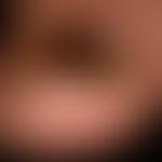 Melanonychia striata longitudinalis: completelysymptomless brown-black longitudinal pigmentation ...