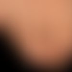 Melanonychia striata longitudinalis: completely asymptomatic brown-black longitudinal pigmentatio...
