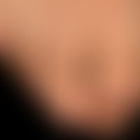 Melanonychia striata longitudinalis: completely asymptomatic brown-black longitudinal pigmentatio...