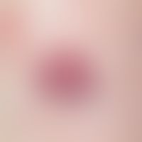 Merkelzell-Karzinom:&nbsp; seit mehreren Monaten bestehender , langsam wachsender, schmerzloser K...