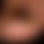 Onychomycosis: Onychomycosis of the entire big toe nail (see whitish, crumbly nail matrix marked ...