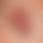 Squamous cell carcinoma in actinically damaged skin: since more than 1 year, slowly growing, very...