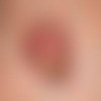Squamous cell carcinoma in actinically damaged skin: since more than 1 year, slowly growing, very...