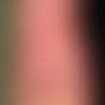 Porphyria cutanea tarda: erworbene PCt&nbsp;mit unvgewöhnlicher Klinik. Flächenhafte Hautschädigu...