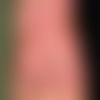 Porphyria cutanea tarda: erworbene PCt&nbsp;mit unvgewöhnlicher Klinik. Flächenhafte Hautschädigu...