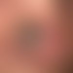 Squamous cell carcinoma in actinically damaged skin.:since > 1year, slowly growing, very firm,...
