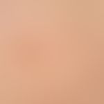 Type I neurofibromatosis, peripheral type or classic cutaneous form. Detail view. Several café-au...