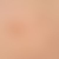 Type I neurofibromatosis, peripheral type or classic cutaneous form. Detail view. Several café-au...