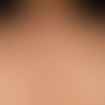 Chronische Lichtalterung der Haut: multiple unregelmäßig konfigurierte, Pigmentflecken unterschie...