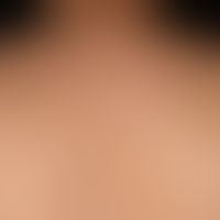 Chronic photo-aging of the skin: multiple irregularly configured pigment spots of varying colour ...