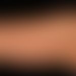 Chronische Lichtalterung der Haut: nur mäßiggradig&nbsp;ausgeprägte Lichtalterung der Haut; fläch...