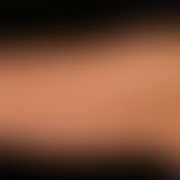Chronische Lichtalterung der Haut: nur mäßiggradig&nbsp;ausgeprägte Lichtalterung der Haut; fläch...