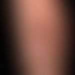 Syphilis: multiple papular or papulo-necrotic, painless syphilis II, untreated!
