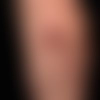 Syphilis: multiple papular or papulo-necrotic, painless syphilis II, untreated!
