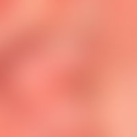 Teleangiectasia: harmless, linear, irregular vascular dilatation in the cheek area.
