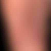 Tinea pedum:&nbsp;Detailaufnahme.&nbsp;Seit&nbsp; Monaten&nbsp;persistierende groblamelläre Schup...