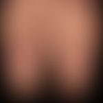 Tinea pedum: General view: For months persistent scaling with moderate itching; blurred, marginal...