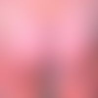 Varizellen:&nbsp;generalisiertes Exanthem (Aspekte des Erythema multiforme)&nbsp;mit Nebeneinande...