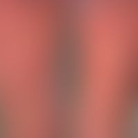 Varizellen:&nbsp;generalisiertes Exanthem (Aspekte des Erythema multiforme)&nbsp;mit Nebeneinande...