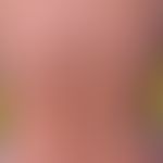 Varizellen:&nbsp;generalisiertes Exanthem (Aspekte des Erythema multiforme)&nbsp;mit Nebeneinande...