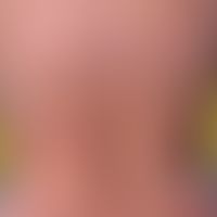 Varizellen:&nbsp;generalisiertes Exanthem (Aspekte des Erythema multiforme)&nbsp;mit Nebeneinande...
