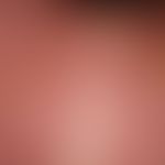 2nd degree burn (Combustio bullosa): erythema with subsequent extensive subepidermal blistering. ...