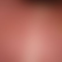 Verbrennung 2. Grades (Combustio bullosa): Erythem mit nachfolgender, flächenhafter subepidermale...