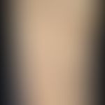 Prurigo simplex subacuata: typical distribution pattern of the interval-like itching, scratched, ...
