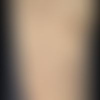 Prurigo simplex subacuata: typical distribution pattern of the interval-like itching, scratched, ...