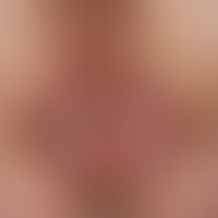 Condylomata gigantea: cauliflower-like, exophytic and locally infiltrating fibroepithelial prollf...