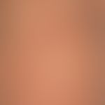Sclerema adiposum neonatorum: skin and subcutaneous tissue that has existed since birth and is in...