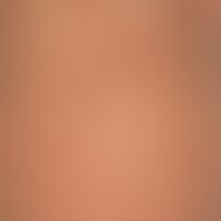 Sclerema adiposum neonatorum: skin and subcutaneous tissue that has existed since birth and is in...