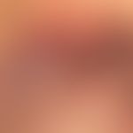 Pemphigus vulgaris:&nbsp;multiple, chronische, seit 3 Jahren schubweise verlaufende Ausbildung vo...