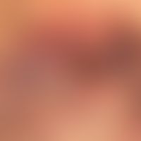 Pemphigus vulgaris:&nbsp;multiple, chronische, seit 3 Jahren schubweise verlaufende Ausbildung vo...