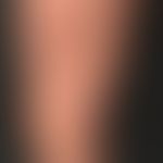 Sklerofaszie: Seit Monaten zunehmende, Verhärtung und Einsenkung der Oberschenkeltextur. Diagnose...