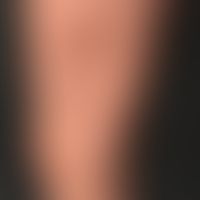 Sclerofascia: increasing for months, hardening and subsidence of the texture of the thigh; diagno...