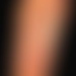 Palmar and plantar filids: disseminated, reddish-brown, scaly papules on palms and soles; no itch...