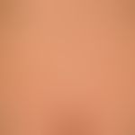Syphilis acquisita:&nbsp;papulöses, völlig asymptomatisches&nbsp;(Rezidiv-)Exanthem (kein Juckrei...
