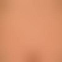 Syphilis acquisita: papular, completely asymptomatic (recurrent) exanthema (no itching) Important...