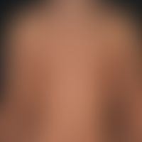 Syphilis acquisita: maculo-papular exanthema.
