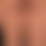 Syphilis acquisita:&nbsp;papulöses, völlig asymptomatisches&nbsp;(Rezidiv-)Exanthem (kein Juckrei...