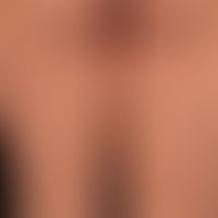 Syphilis acquisita:&nbsp;papulöses, völlig asymptomatisches&nbsp;(Rezidiv-)Exanthem (kein Juckrei...