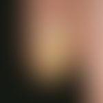 Yellow-nail-Syndrom:&nbsp;gelblich verfärbter und gleichmäßig verdickter&nbsp; Daumennagel mit Be...