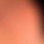Nodules skin-coloured: flat, moderately firm nodules protruding above the skin level with a field...