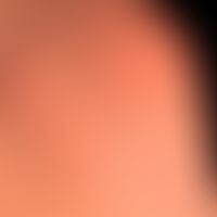 Nodules skin-coloured: flat, moderately firm nodules protruding above the skin level with a field...