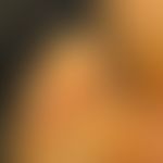 Keratoma sulcatum: 33-year-old man with habitually very sweaty feet + occupational safety shoes a...