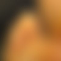 Keratoma sulcatum: 33-year-old man with habitually very sweaty feet + occupational safety shoes a...