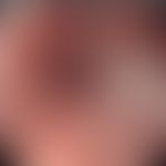 Soorösophagitis endoskopischer Befund mit weißlichen Plaques (Pfeil). Entommen aus:&nbsp; Mohamed...