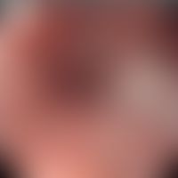 Soorösophagitis endoskopischer Befund mit weißlichen Plaques (Pfeil). Entommen aus:&nbsp; Mohamed...