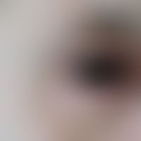 Chalazion: schmerzlose, derbe und knotige Schwellung mit angedeuteter Rötung am unteren Augenlid....